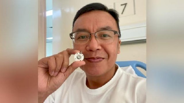 Ari Lasso menunjukkan chemo port yang telah dilepas dari tubuhnya. Foto: Instagram/ari_lasso