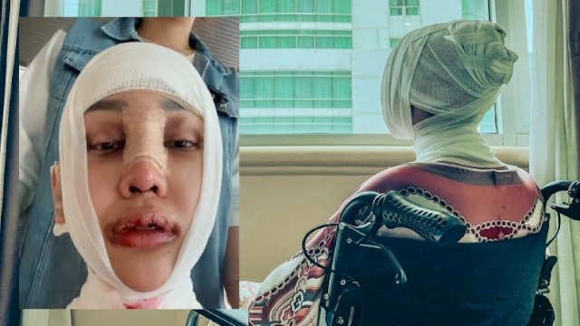 Lucinta Luna pasca operasi "potong leher" (int)