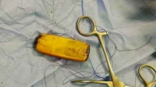 penampakan ponsel usai dikeluarkan dari perut narapidana 