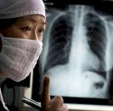 Jumlah Penderita Tuberkulosis Meningkat Tiap Tahun