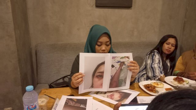 SA saat memperlihatkan bukti luka-luka ditubuhnya akibat KDRT yang dilakukan suami yang seorang anggota Polri/Ist