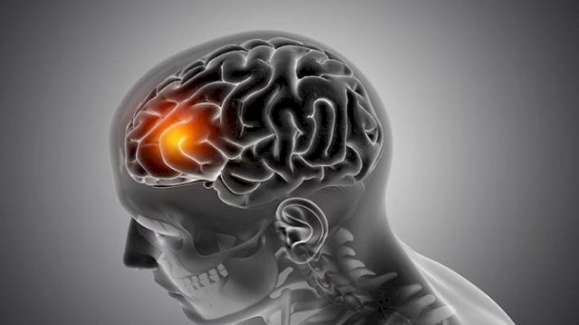 Mengenal Diffuse Axonal Injury yang Diderita David Usai Dianiaya Anak Eks Pegawai Pajak