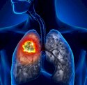 Kenali Gejala Paru-paru yang Tidak Sehat