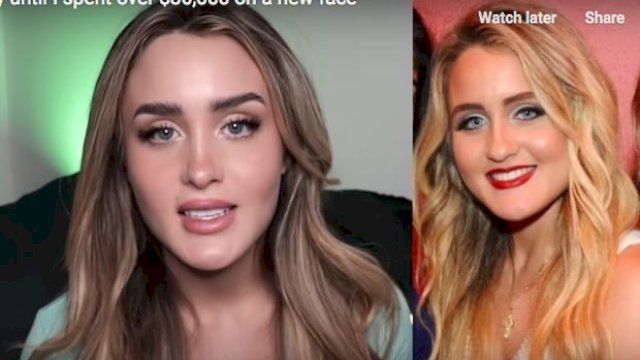 Merasa Jelek, Influencer di AS Habiskan Ratusan Juta Demi Ubah Wajah