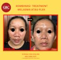 Klinik GBC Kemanggisian Ungkap Rahasia Kulit Bebas Flek