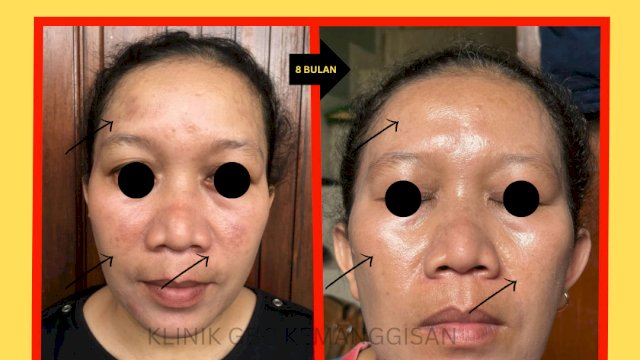 Klinik GBC Kemanggisian Ungkap Rahasia Kulit Bebas Flek