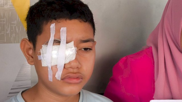 Siswa&nbsp;SMP di Gowa Alami Cedera Mata Usai Dipanah Teman Pakai Tusuk Bakso
